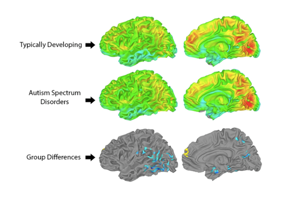 자폐 스펙트럼 장애(ASD)를 가진 청소년과 신경전형적인 청소년의 뇌 활동에는 차이가 있다. 샌디에이고주립대학 