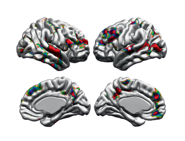 자폐 아동, 성별따라 대뇌피질 발달 차이 보여